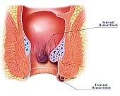 Le emorroidi esterne necessitano di un regime alimentare mirato a regolarizzare il transito intestinale.