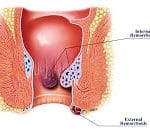 Emorroidi sangue - Dolore ano defecazione e non